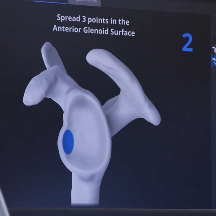 Robotic-assisted shoulder replacement at Norton Hospital